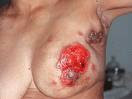 cáncer de mamas