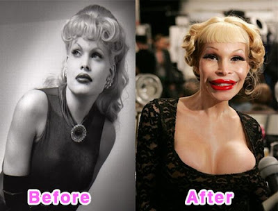 Celebrity Plastic Surgery on Fresh Pic  16 Worst Celebrity Plastic Surgery Disasters