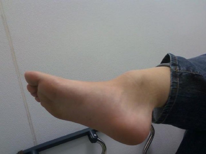 Broken ankle blue image