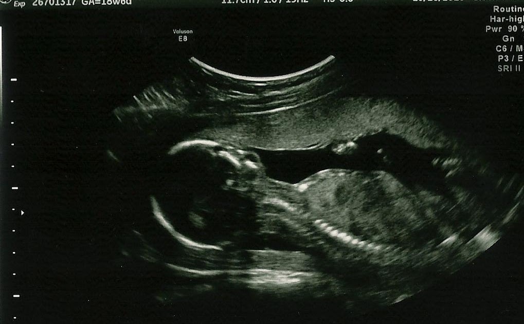 crib rock 19 week ultrasound