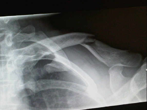 [Fractured+Collarbone.jpg]