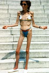 ANOREXIA