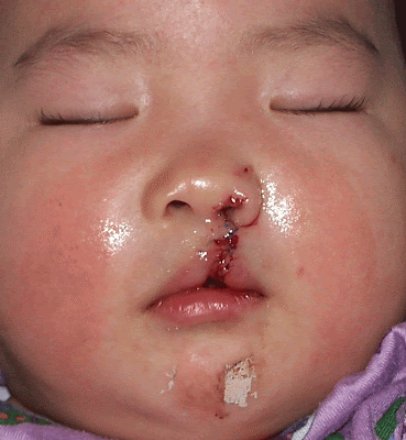 fetus   causes of cleft chin and palate
