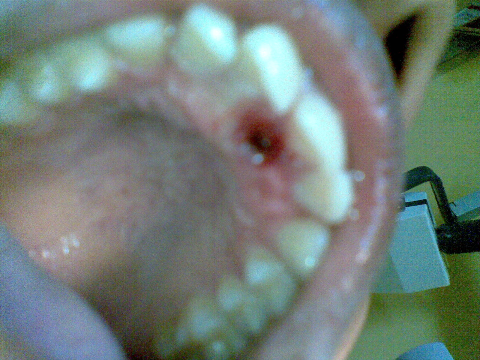 Dr Azhar Chisti Extraction of Mesiodens.Case report by Dr Azhar Chisti