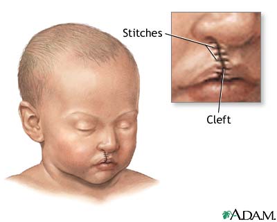 Cleft palates may also cause