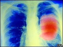 vacuna contra el cancer de pulmón