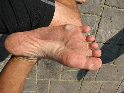 Gnarly Feet