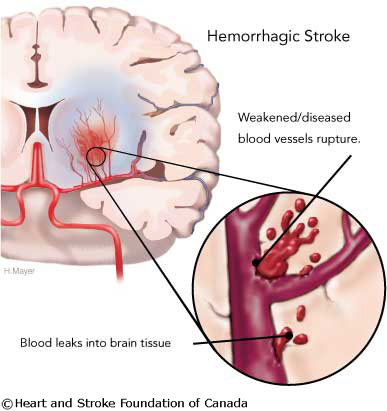 images of stroke