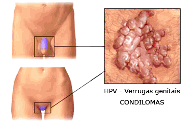 como prevenir a doença dst