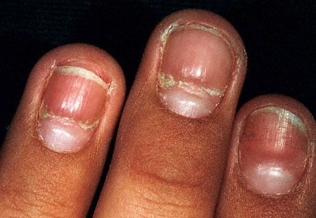 The condition of your nails may offer clues to your general health