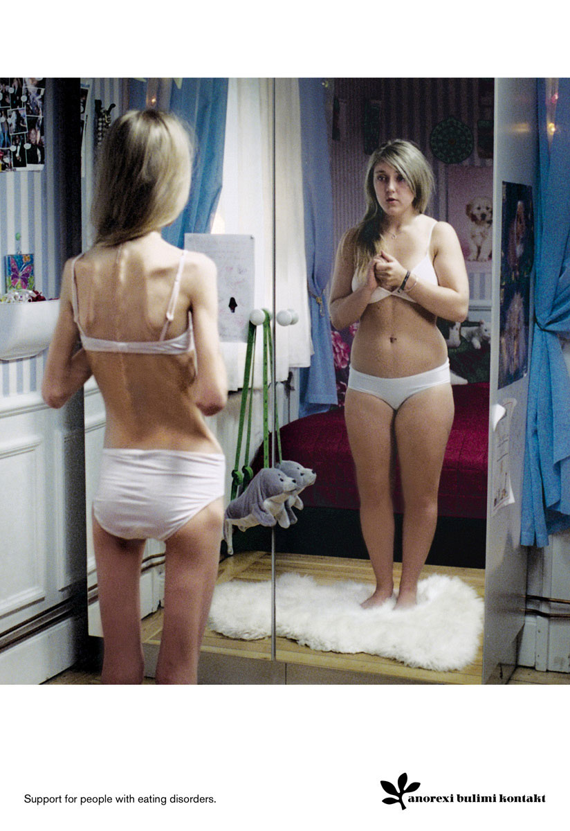 Anorexia