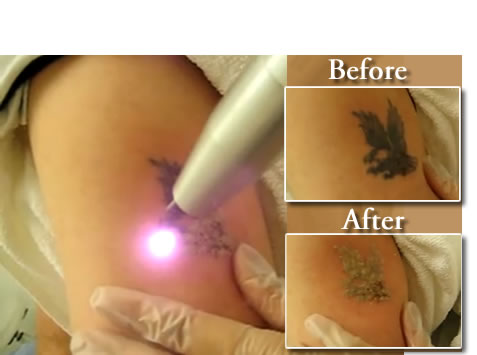Q-Switch Nd:YAG Laser tattooed removal laser machine
