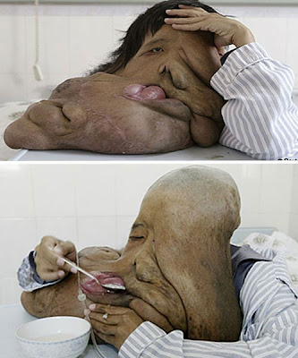 Human Elephant Disease