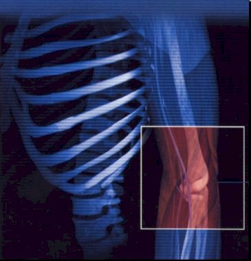 [epicondilitis+2.jpg]