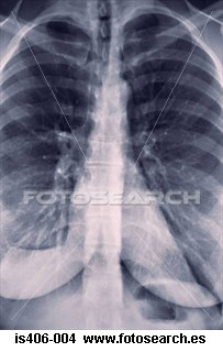 [RADIOGRAFÃ A+PULMONES.jpg]