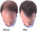 [minoxidil+before+and+after.jpg]