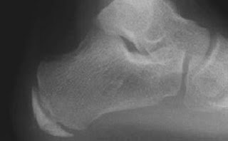 Heel Pain In Kids Heel Pain In Kids