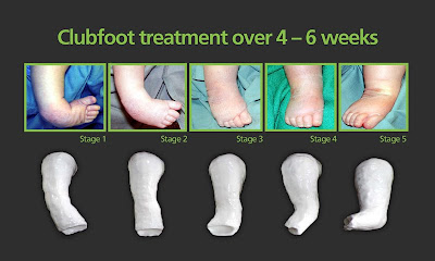 Types Of Clubfoot