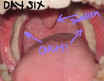 Tonsils After Tonsillectomy