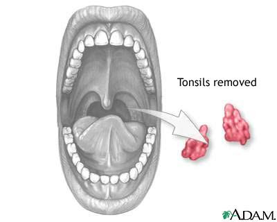 Tonsil Bed