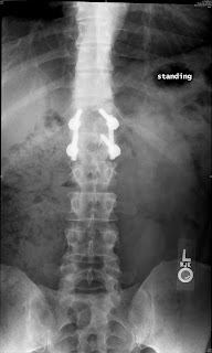 Nexus Expedition: Jan 2009 vertebral column fracture