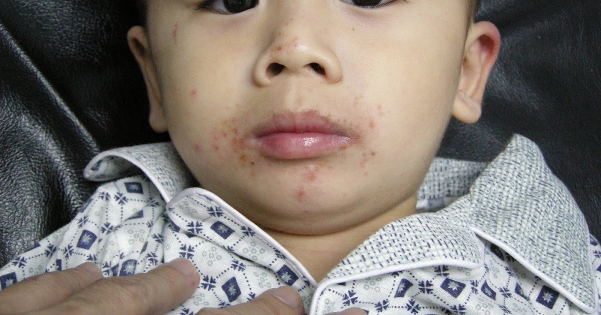 VIRTUAL GRAND ROUNDS IN DERMATOLOGY 2.0 Eczema herpeticum