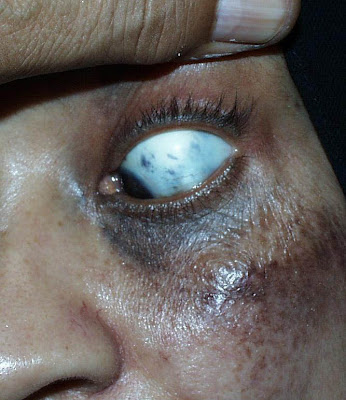 Nevus Ota