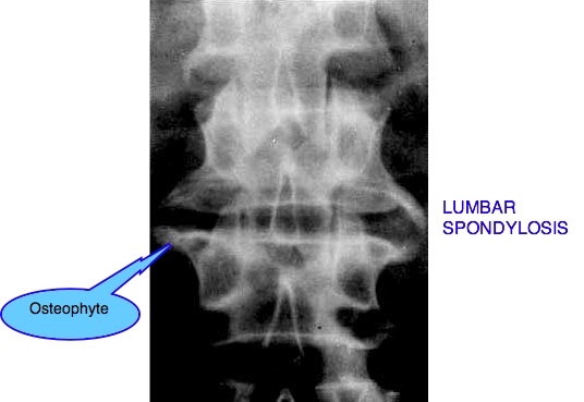Rhoda's CT/MRI Procedures: Lumbar Spondylosis