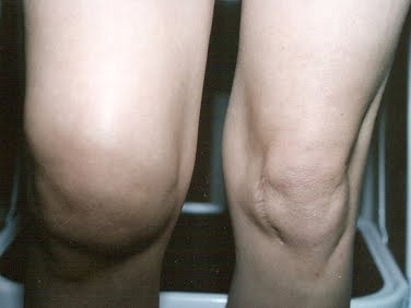 [swollen-knee-1.jpg]
