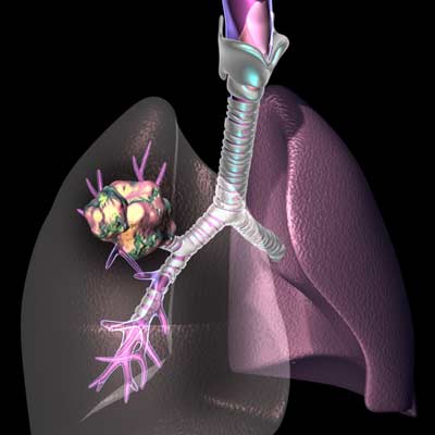 x rays of lung cancer. x rays of lung cancer.
