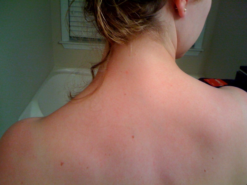 Clopidogrel Side Effects Itching