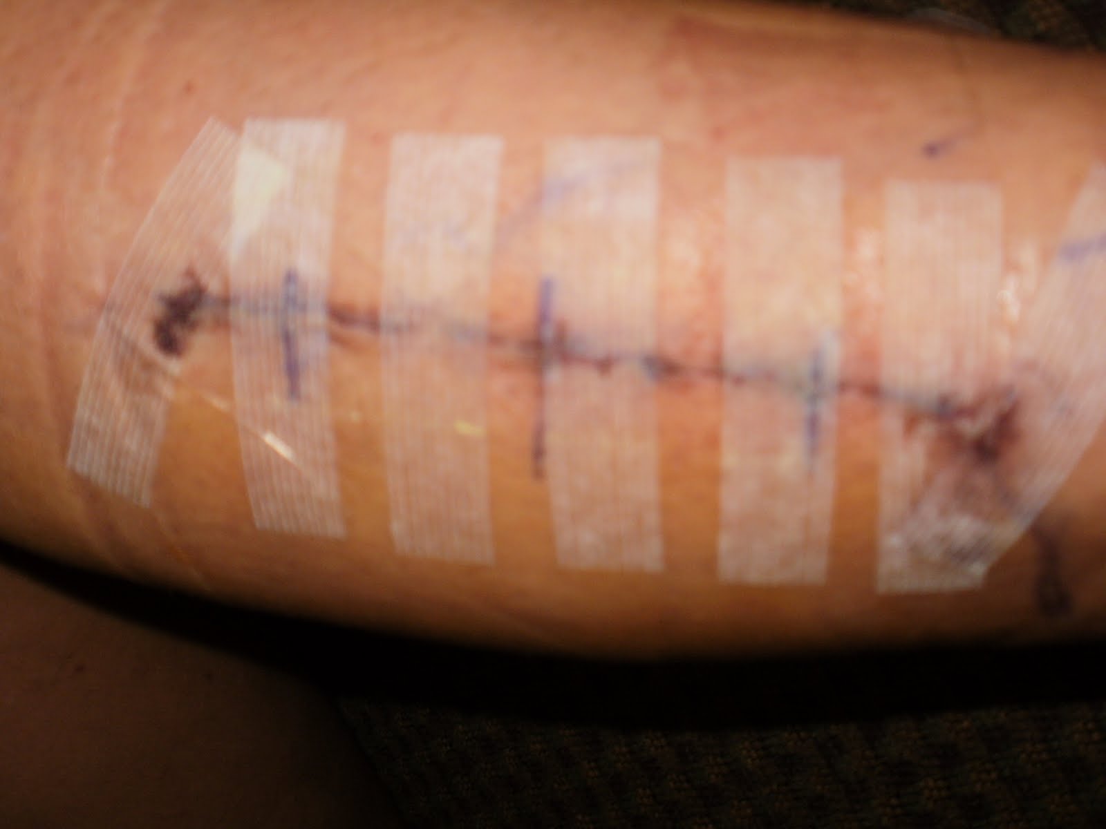 Exertional Compartment Syndrome