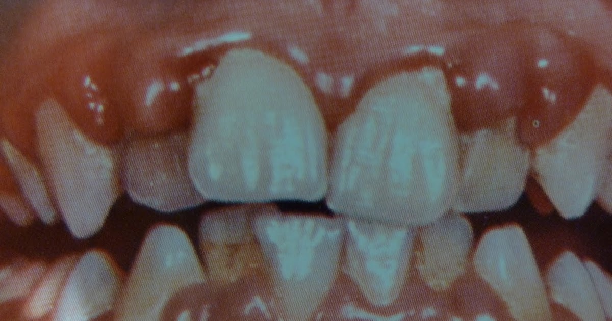 Pregnancy and Dental Health