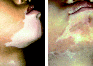 vitiligo surgery