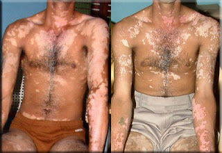 vitiligo new cure