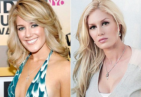 heidi montag after surgery photos. heidi montag after surgery