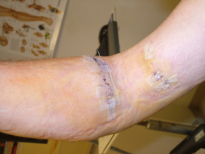 Bicep Tendon Injury