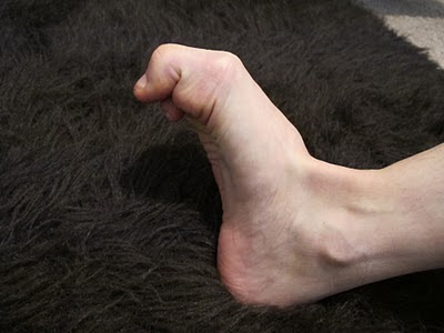 Calcium Supplements Eye Twitch : Jock Itch Or Herpes  Here Is The Best Way To Tell The Difference