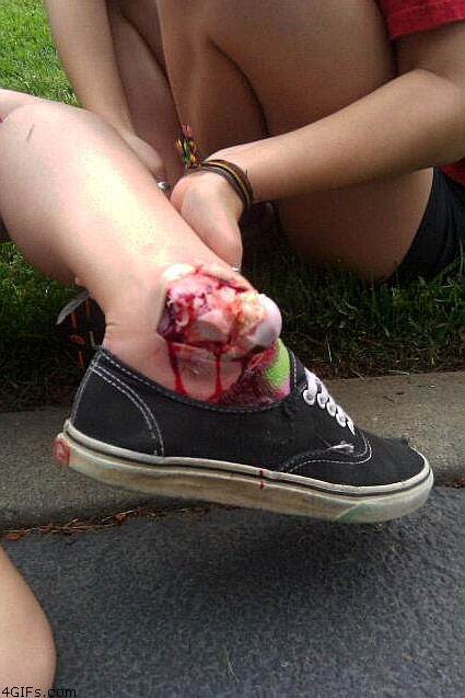 A Compound Fracture