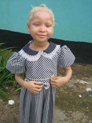 People with albinism have