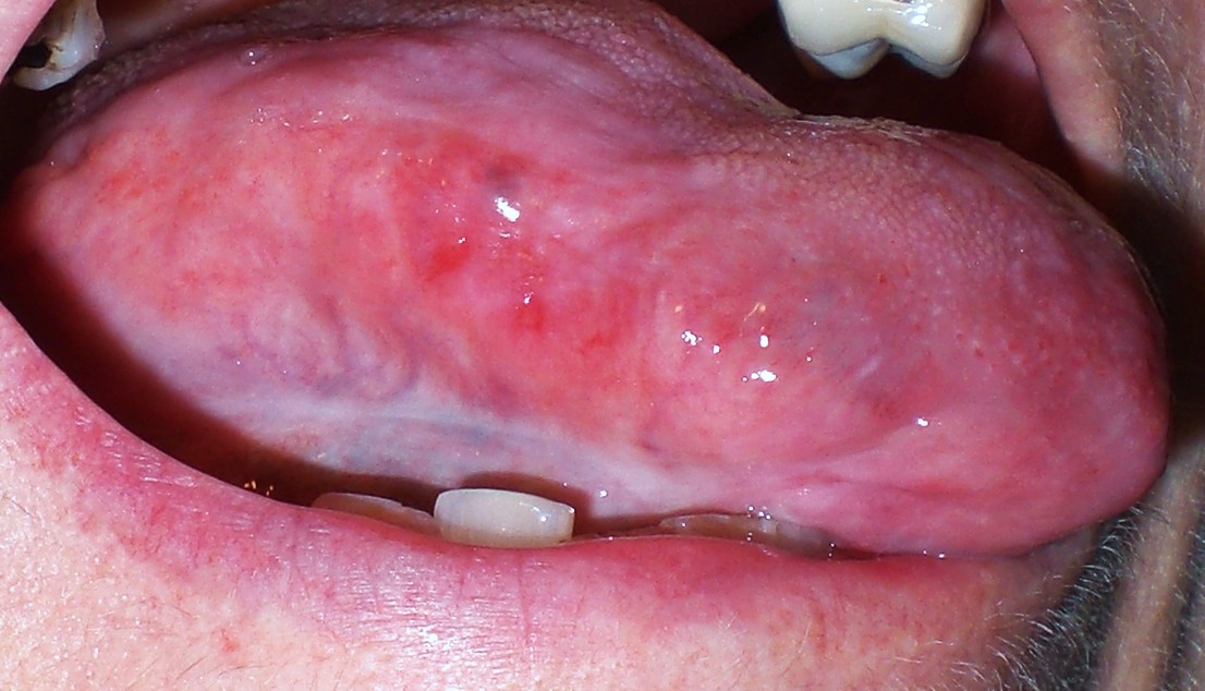 Swollen Glands Under Tongue