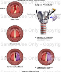 Vocal Fold Surgical Procedure