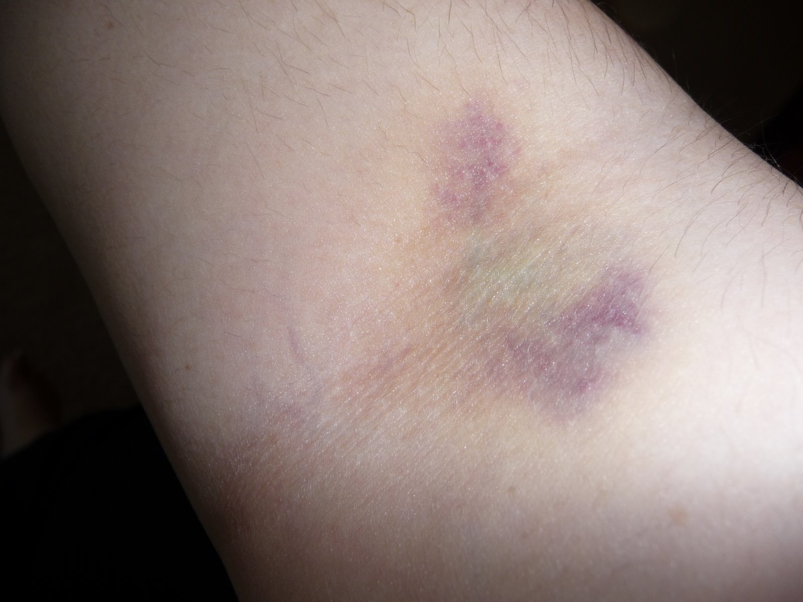 [Day+3+bruise.JPG]