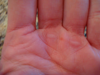 Blisters on hand
