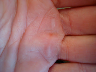 Close up of blisters on hand