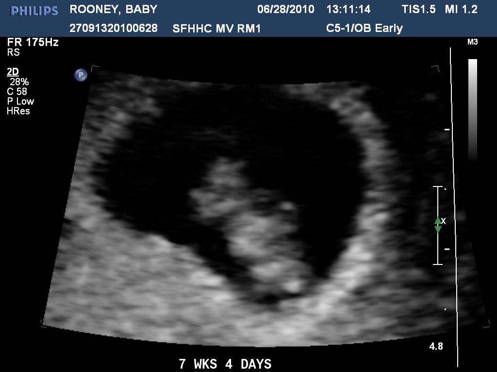 Weeks Pregnant Ultraso...