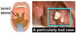 Tonsil Bad Breath Stones : Tonsil Stones Remedy Tips That Work