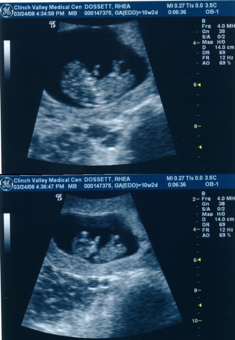 March 24 Ultrasound