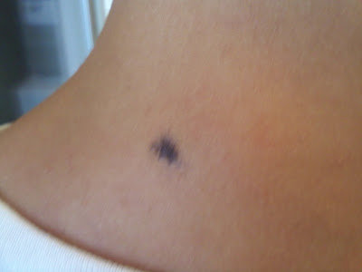 Lamictal Rash Pictures