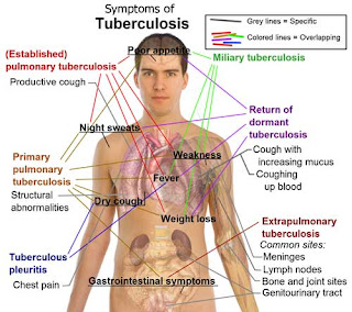 Apa Itu Tuberkulosis Dan Bagaimana Mengatasinya